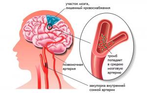 Что такое ишемия головного мозга