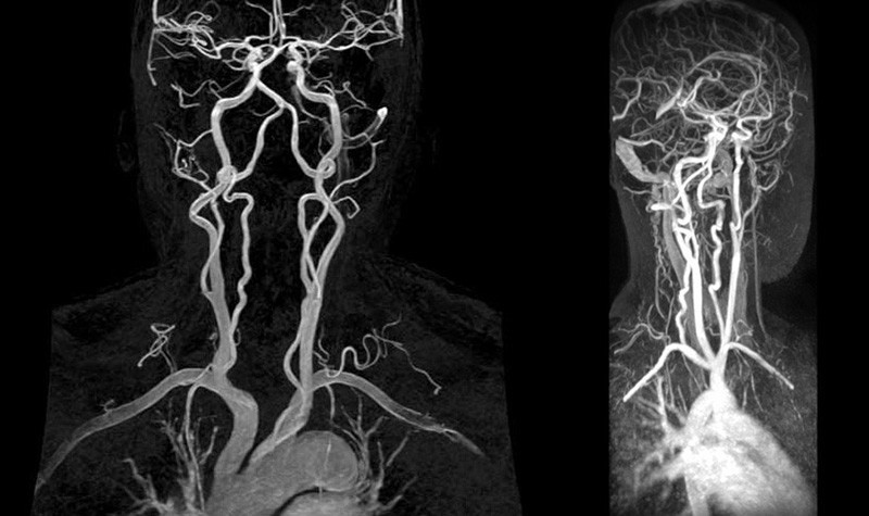 МРТ сосудов и артерий шеи в Тушино
