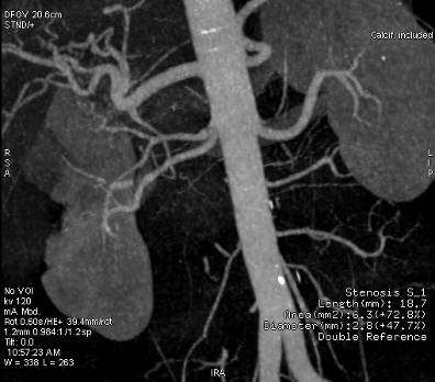 МРТ почечных артерий в Тушино