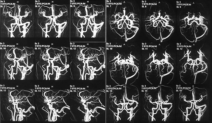 МРТ артерий и вен головного мозга в Тушино