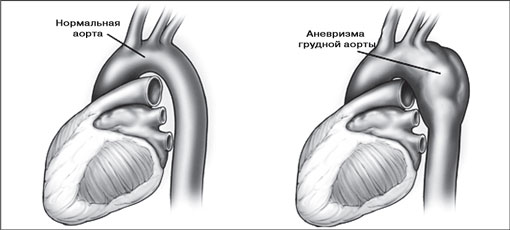 Нормальная аорта и аневризма аорты