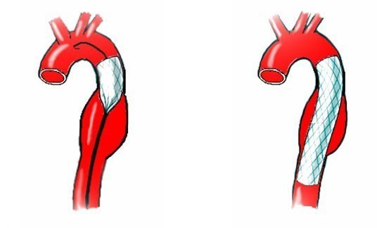 Лечение аневризмы аорты сердца