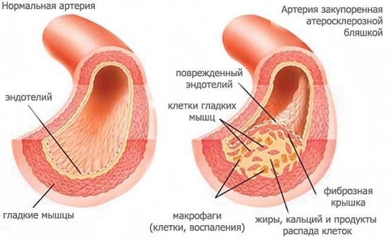 Атеросклерозная бляшка в артерии