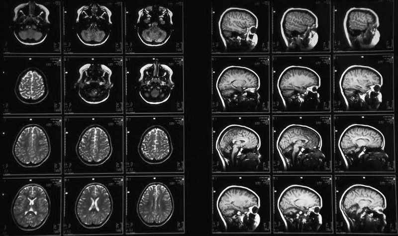 Снимок МРТ головного мозга в Москве