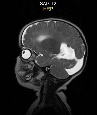 Фото МРТ головы ребенка