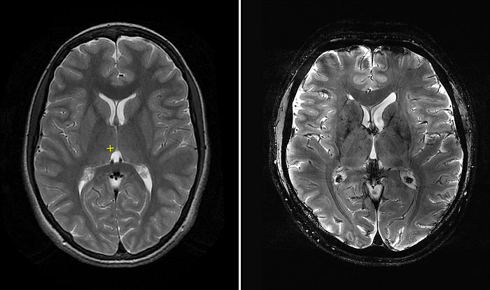 снимок МРТ здорового головного мозга
