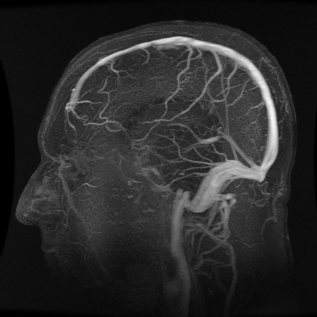 МРТ сосудов головного мозга фото