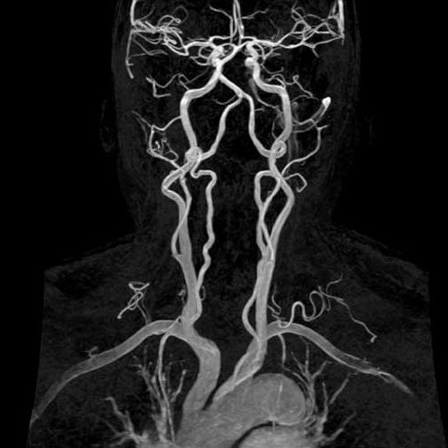 МРТ сосудов головного мозга и шеи, фото