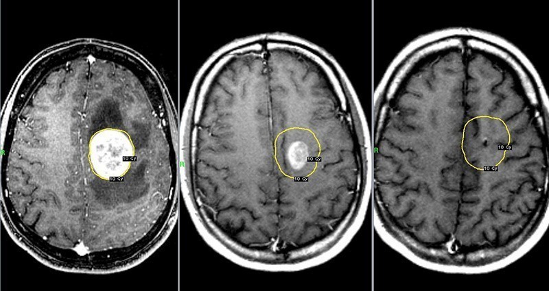 МРТ опухоль мозга