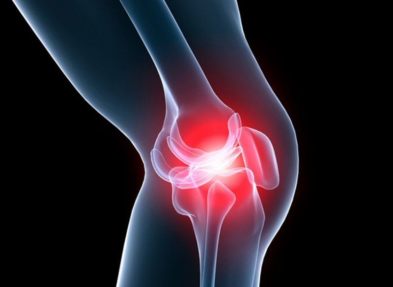 Воспаление коленного мениска – симптомы и постановка диагноза