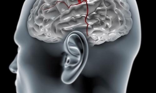 Аневризма сосудов головного мозга. Что это такое. Способы лечения