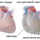 Что такое перикардит: симптомы и лечение заболевания