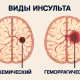 Разновидности инсульта