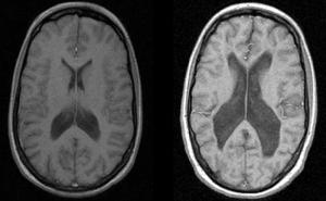 Снимок МРТ головного мозга при шизофрении