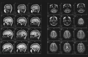 Снимок МРТ головного мозга