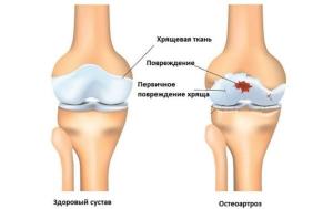остеоартроз коленного сустава 2 степени можно ли вылечить