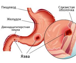 Язвенная болезнь желудка и 12-перстной кишки