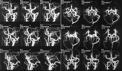 Снимок МРТ сосудов головного мозга