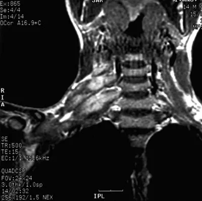 Снимок МРТ плечевых нервных сплетений