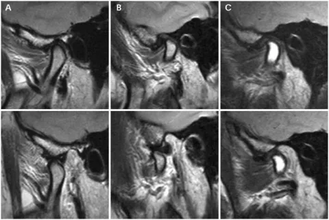 Снимок МРТ челюстного сустава