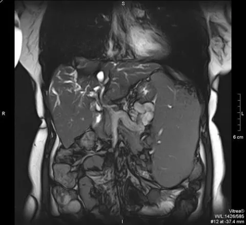 Снимок МРТ брюшной полости