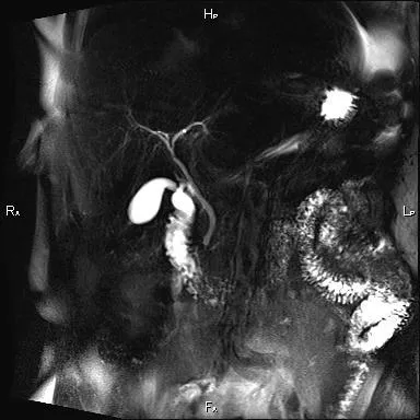 Снимок МРТ желчного мпузыря