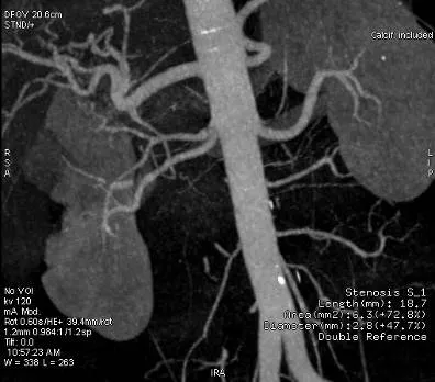 Снимок МРТ почечных артерий