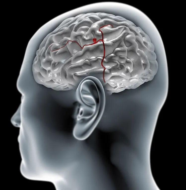 Аневризма сосудов головного мозга
