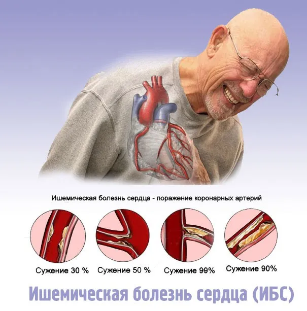 Симптомы ишемической болезни сердца