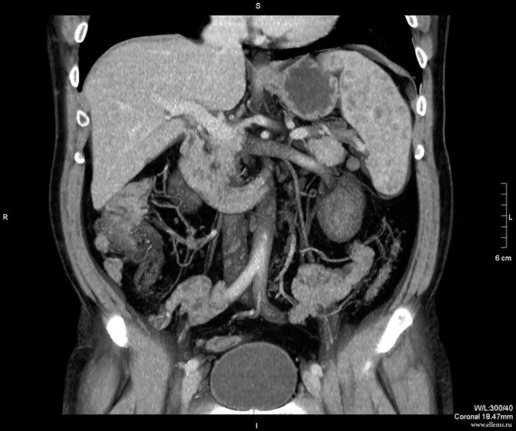 Снимок МРТ брюшной полости