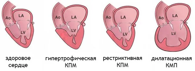 Разновидности кардиомиопатии сердца