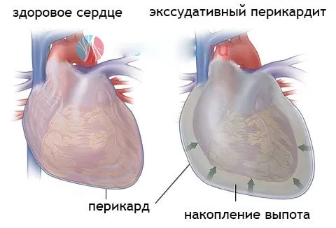 Что такое перикардит: симптомы и лечение заболевания