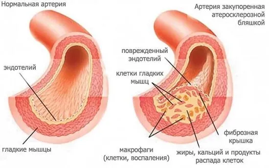 Нормальная и закупоренная артерия