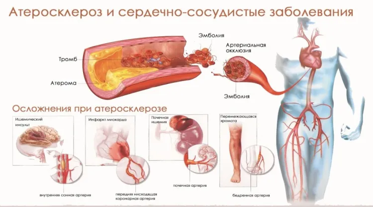 Атеросклероз и сердечно-сосудистые заболевания