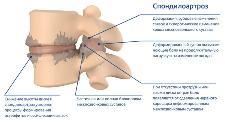 Спондилоартроз