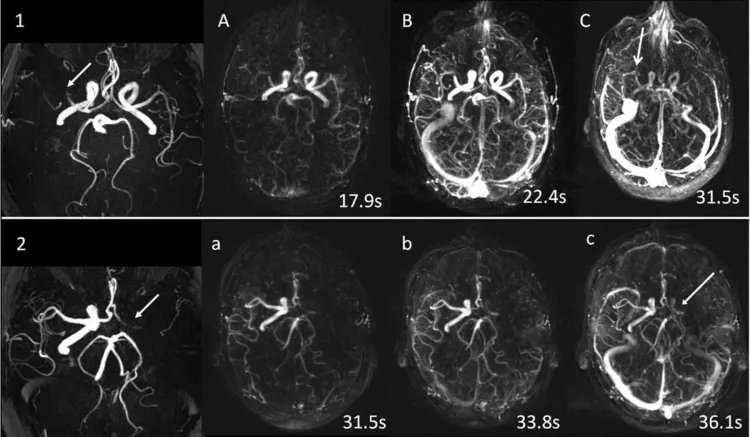 Снимок МРТ сосудов головного мозга