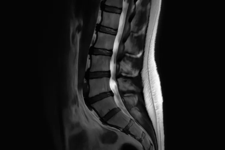 Вертеброгенный болевой синдром