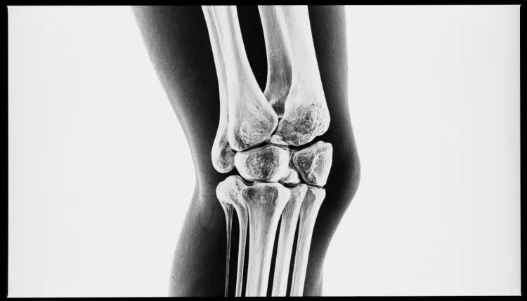 МРТ коленного сустава Строгино