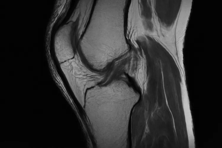 снимок мрт коленного сустава